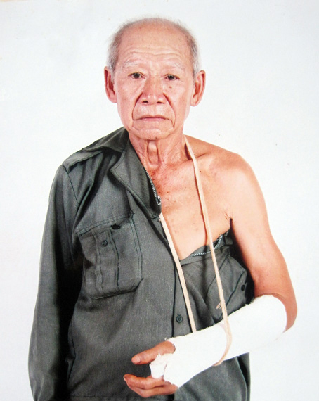 Sau lần bị té ngã khi đi nhận xe, tay ông Nguyễn Văn Trạch hiện vẫn bị bó bột. Ảnh: M. Đăng