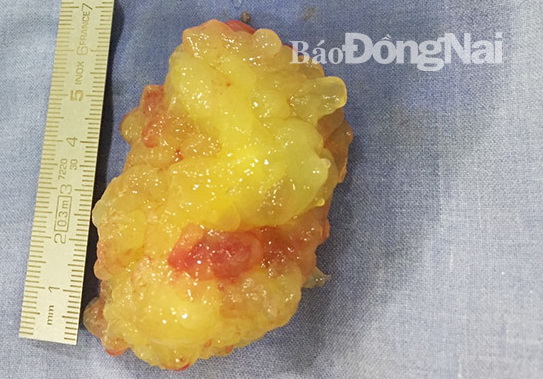 Phẫu thuật cấp cứu lấy 2 khối u trong tim bệnh nhân