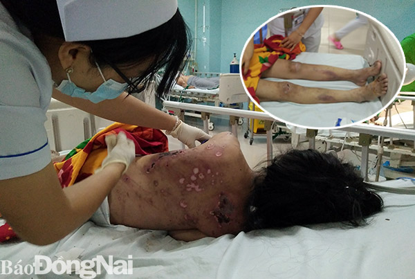 Chị T. đang nằm điều trị tại Bệnh viện đa khoa Đồng Nai với rất nhiều thương tích trên người.