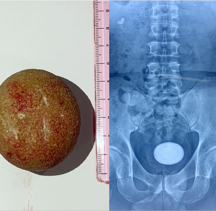 Viên sỏi có kích thước 5cm được lấy ra từ bàng quang của bệnh nhân.