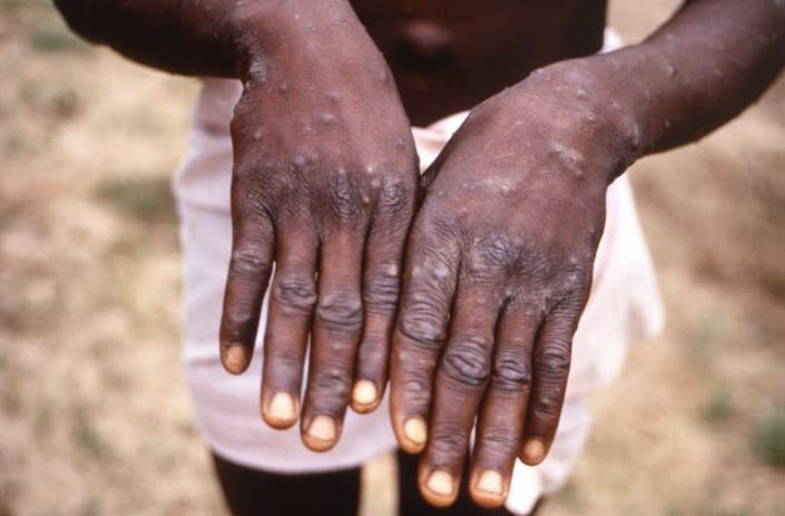 Close-up of monkeypox lesions on the hands of a patient during the recuperative stage of the virus, Democratic Republic of the Congo, 1997. 