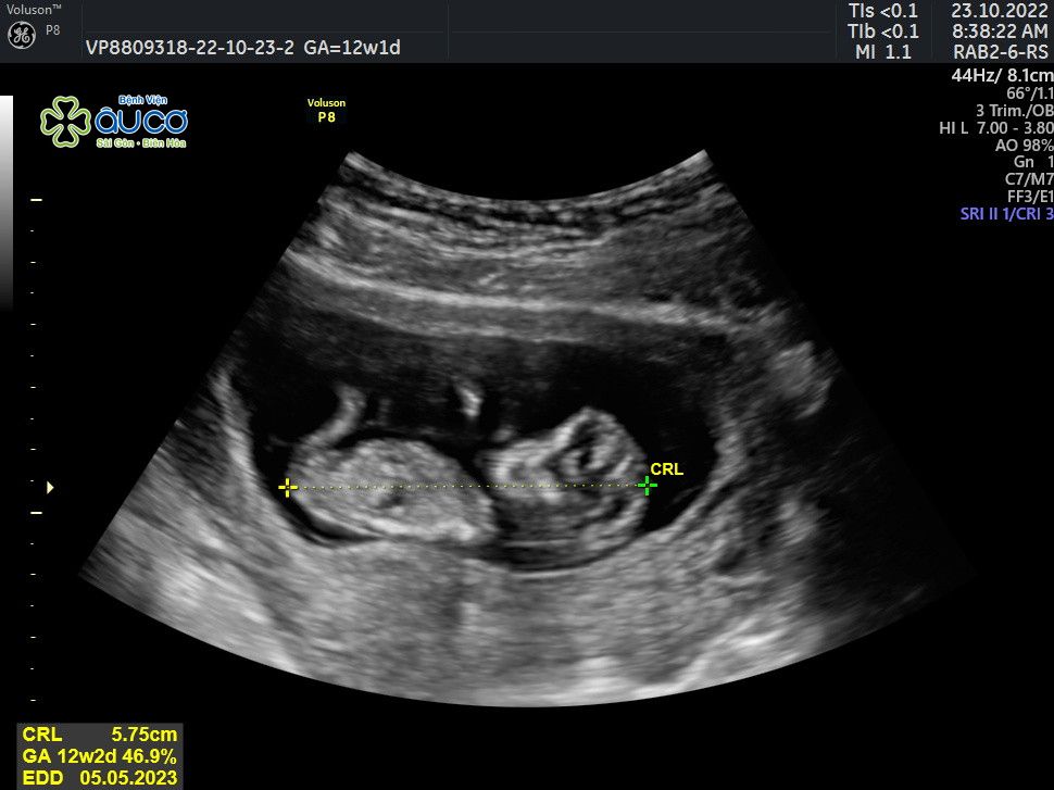 Cái kết viên mãn của hành trình 3 năm tìm con